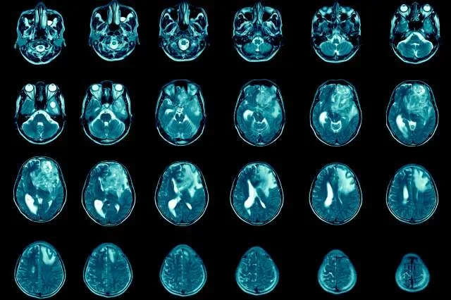 Blue MRI scans of a patient with glioblastoma.