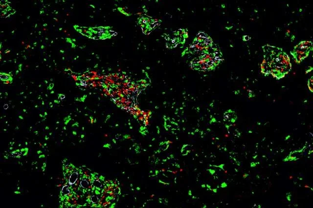 example ihc imaage of perivascular cuffing in brain metastases