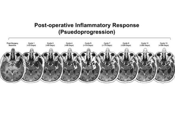 Progressive MRI scans depicting pseudoprogression in a patient post-operation.