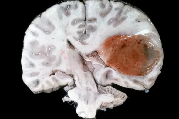 example of a glioblastoma growing in a patient's brain